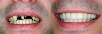 Smile Gallery - Integra Dental, Chicago Dentist