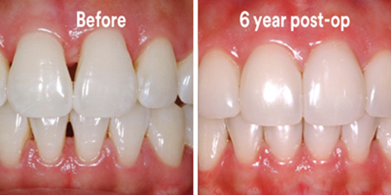 BioClear Diastema Closure and Black Triangle Closure  - Integra Dental, Chicago Dentist