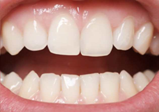Cosmetic Bonding  - Integra Dental, Chicago Dentist