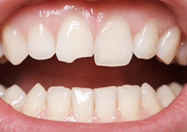 Cosmetic Bonding  - Integra Dental, Chicago Dentist