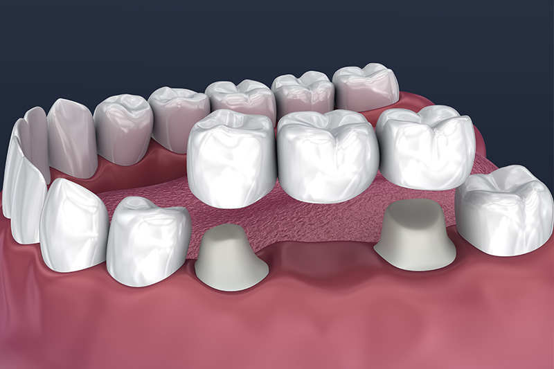 Crowns and Bridges, Inlays and Onlays  - Integra Dental, Chicago Dentist