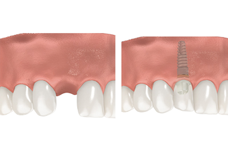 Dental Implants - Integra Dental, Chicago Dentist