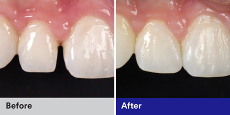 BioClear Diastema Closure and Black Triangle Closure  - Integra Dental, Chicago Dentist