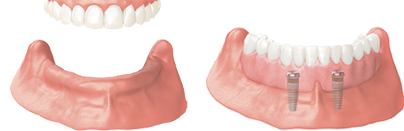 Implant Overdentures and Fixed All-On-X Treatment  - Integra Dental, Chicago Dentist