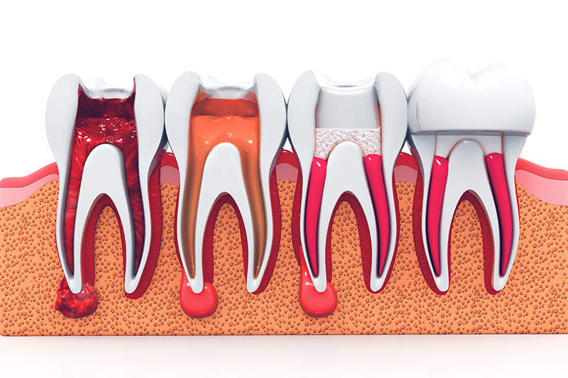 Terapia de Endodoncia  - Integra Dental, Chicago Dentist