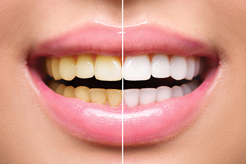 Teeth Whitening - Integra Dental, Chicago Dentist