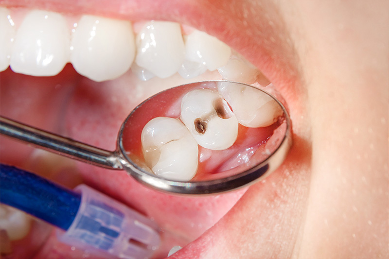 Tooth Colored Composite Fillings  - Integra Dental, Chicago Dentist