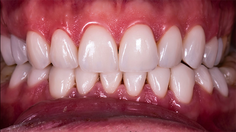 Veneers  - Integra Dental, Chicago Dentist