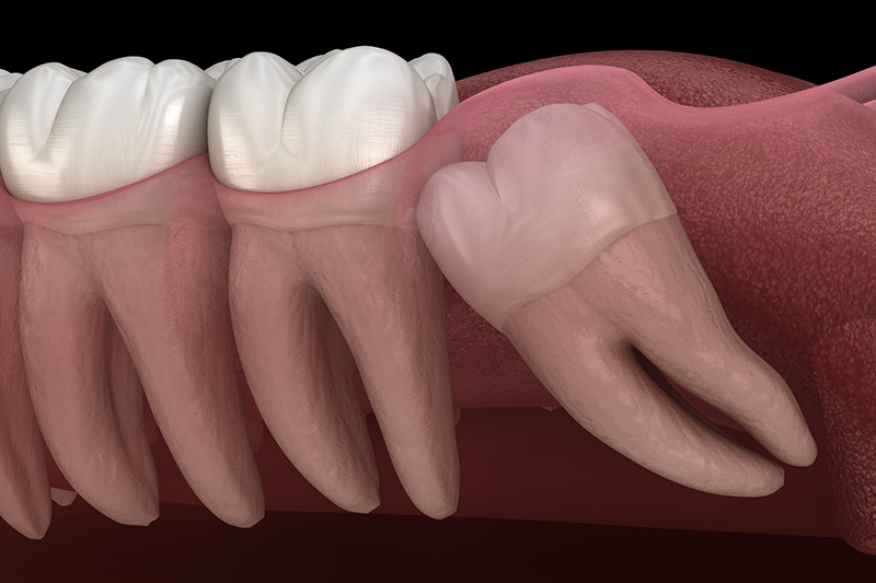 Extracciones de Muelas del Juicio (con Sedante)  - Integra Dental, Chicago Dentist